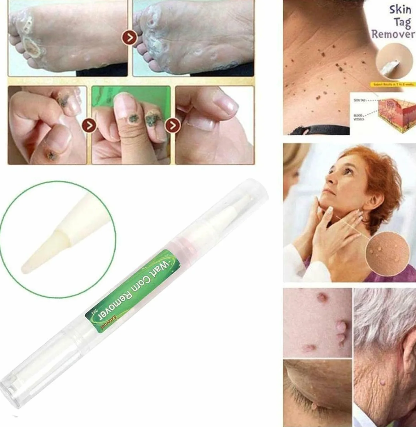 Genital Wart Treatment Papillomas Removal Liquid 3ml