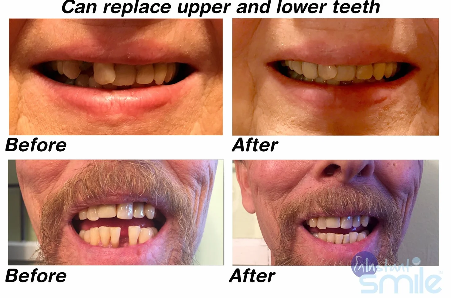 Opatentowany tymczasowy zestaw do naprawy zębów Instant Smile Multishade, wymień brakujący ząb w kilka minut