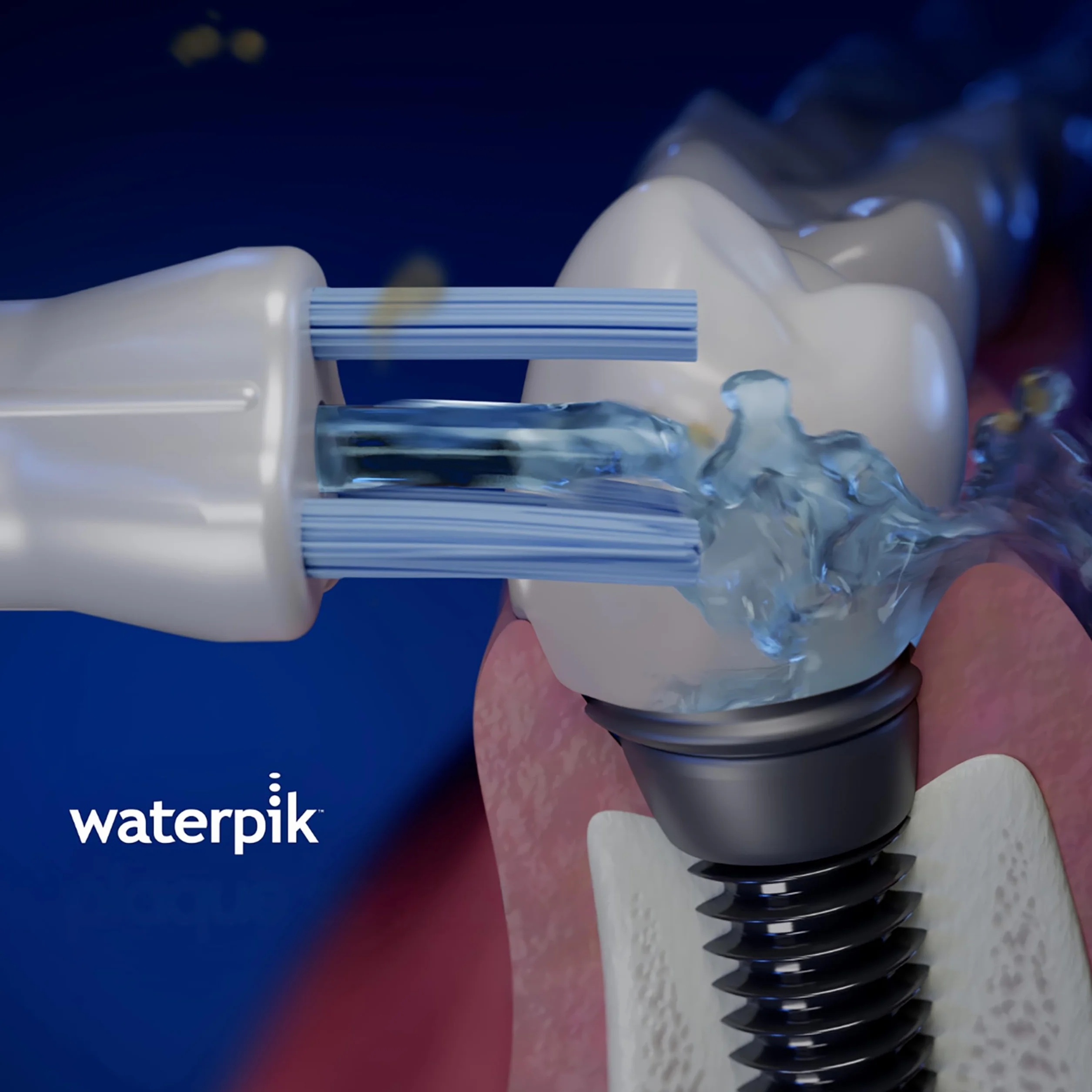 Waterpik Końcówka do Irygatora Plaque Seeker, Wymienna Końcówka do Czyszczenia Implantów, Koron, Mostków, Działa z Modelami WP-450 i WP-100, 2 Sztuki (PS-100E)