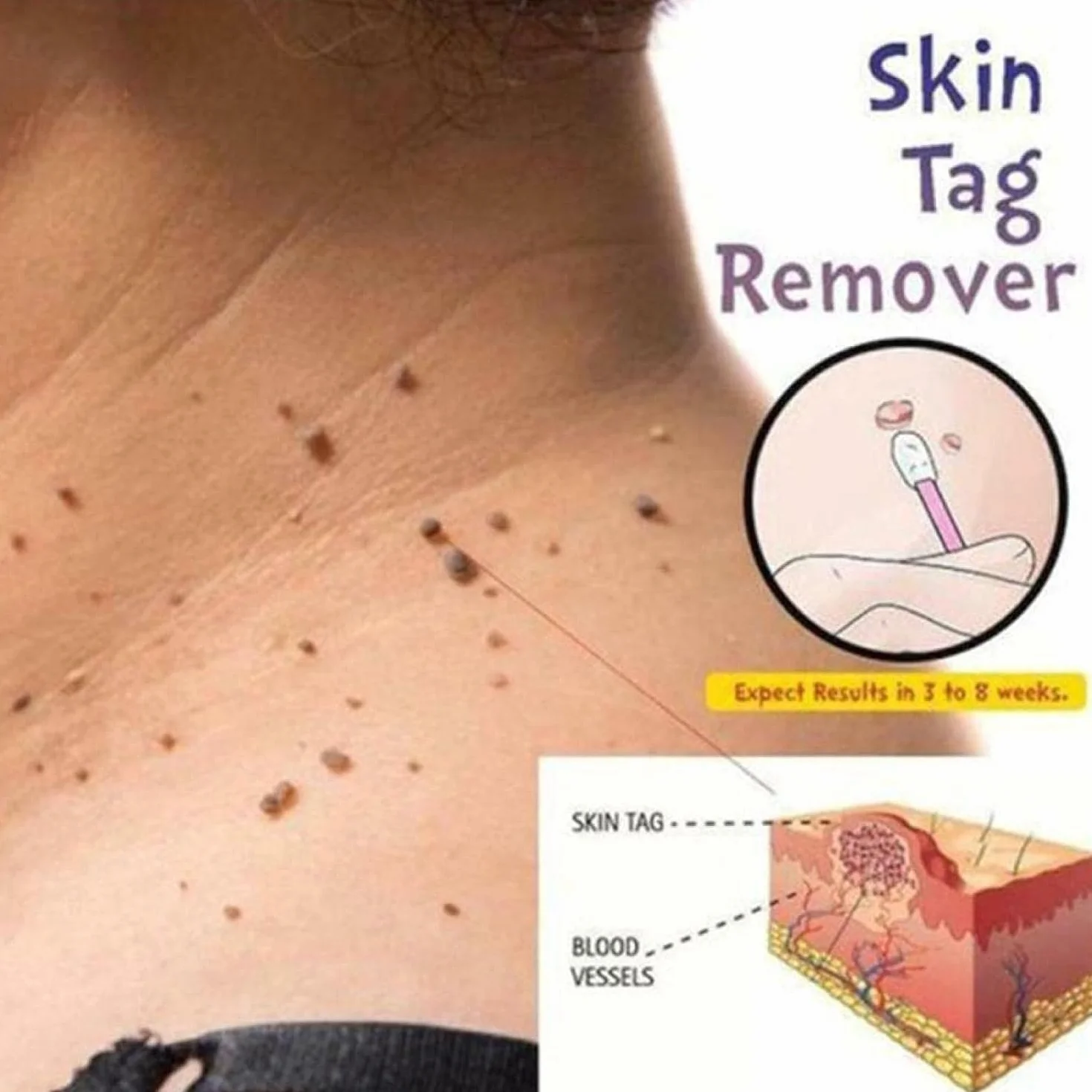 Genital Wart Treatment Papillomas Removal Liquid 3ml