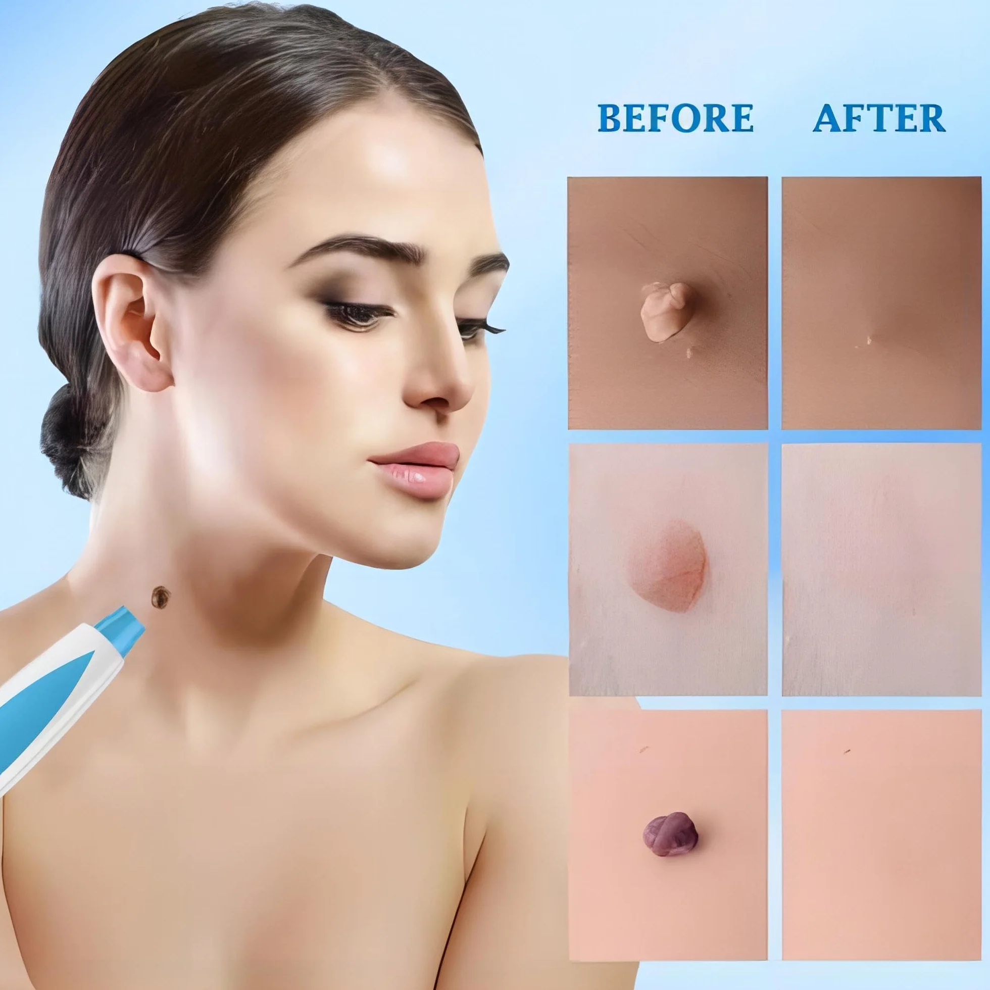 Auto Skin Tag Remover zestaw do usuwania brodawek 3 w 1 (1-8 mm)