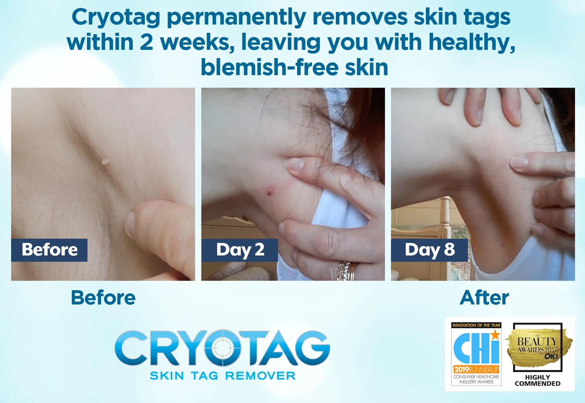 Cryotag Skin Tag Remover 12 zabiegów usuwanie brodawek