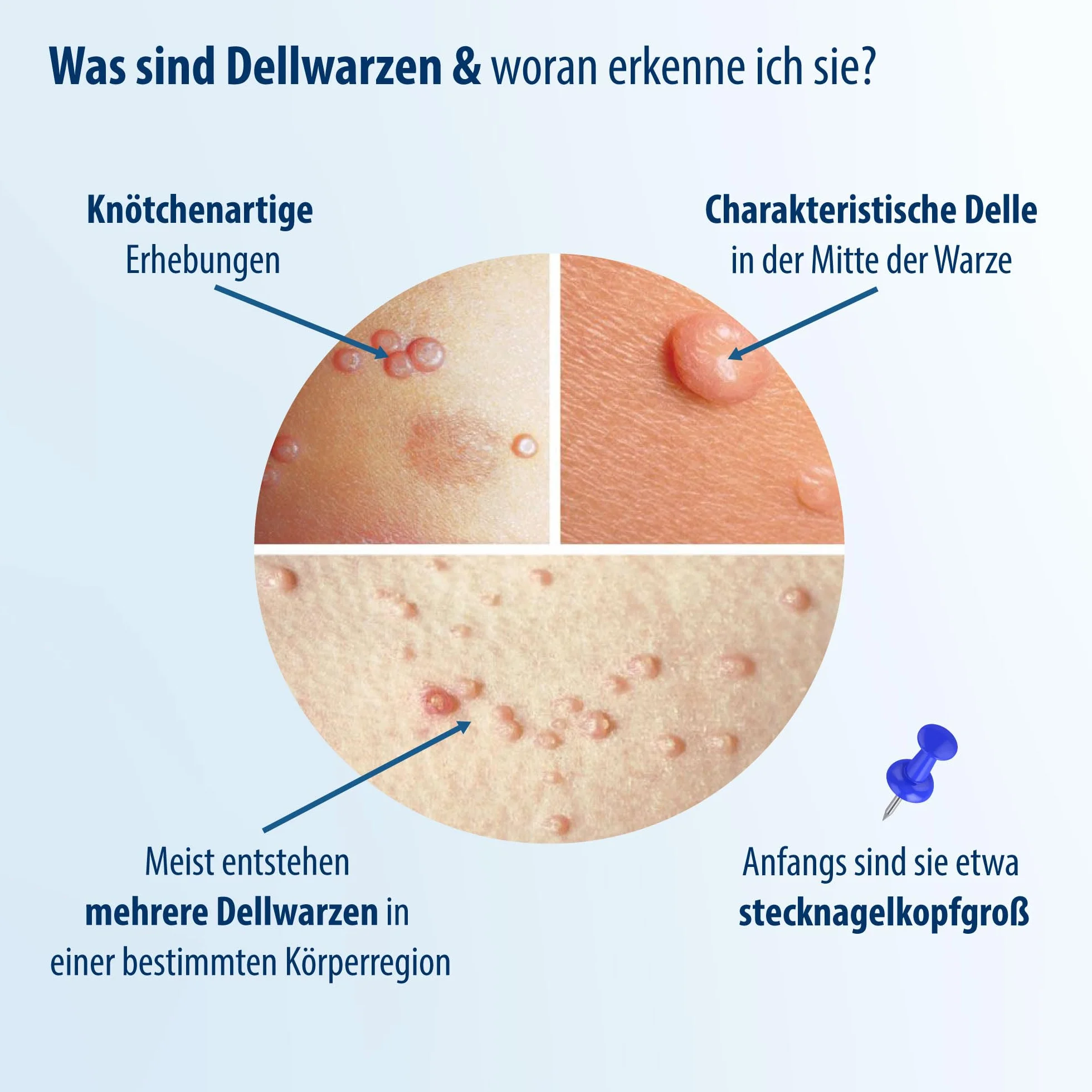 Evolsin Środek na brodawki zakaźne dla dzieci i dorosłych od 2 lat