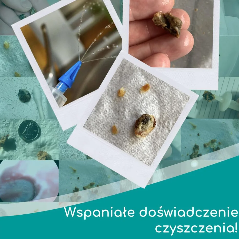 Zestaw ze Strzykawką do Płukania Uszu – 3 x Miękkie Końcówki Quad-Stream do Usuwania Woskowiny od Medi Grade – Wielokrotnego Użytku – Naturalna Metoda Czyszczenia Uszu do Użytku Domowego