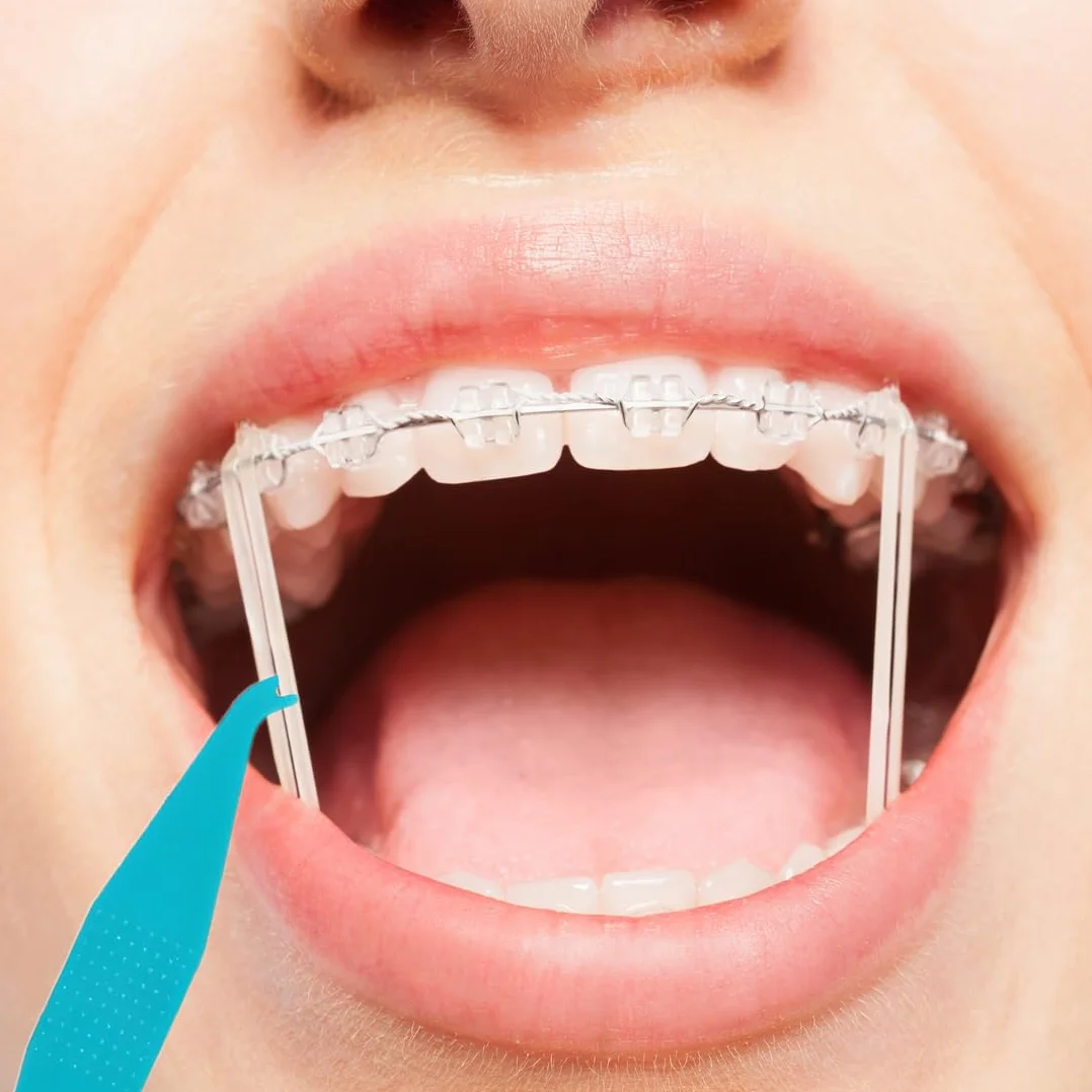 WeddHuis 8 sztuk jednorazowe elastyczne ortodontyczne plastikowe szelki materiał Umieszczenie elastyczne narzędzia do usuwania liny hak