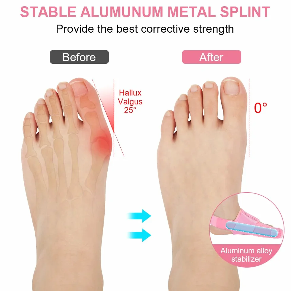 ACWOO Korektor koślawego palucha koślawego dla kobiet i mężczyzn, duży zestaw korektora palucha koślawego z 2 x ortopedycznymi klinami koślawymi i 2 x prostującymi duży palec u nogi do wsparcia na