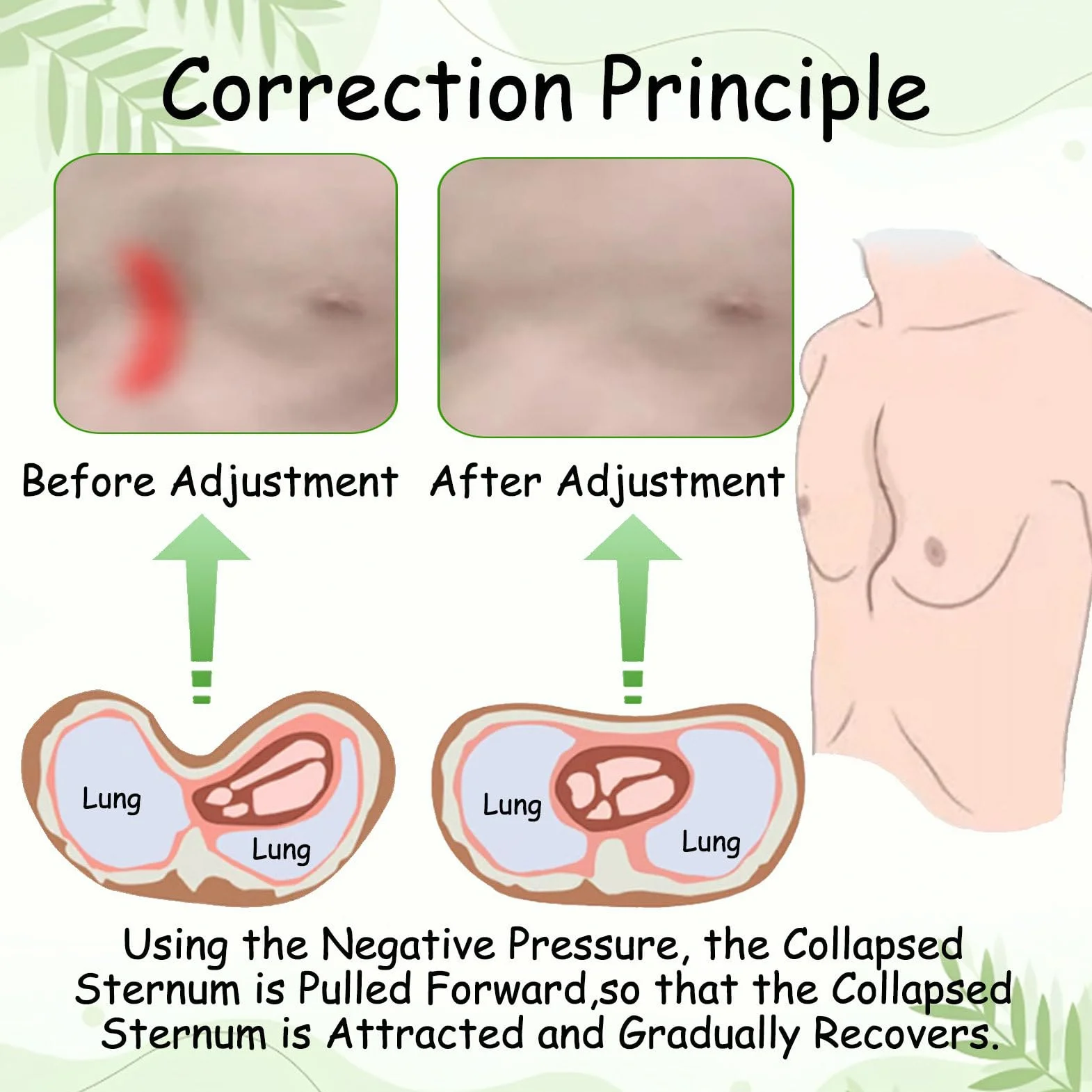 Pectus Excavatum Vacuum Bell, Orteza Na Klatkę Piersiową Dla GołęBi, UrząDzenie Korekcyjne Z Manometrem, Terapia Dzwonem PróżNiowym Standard-S