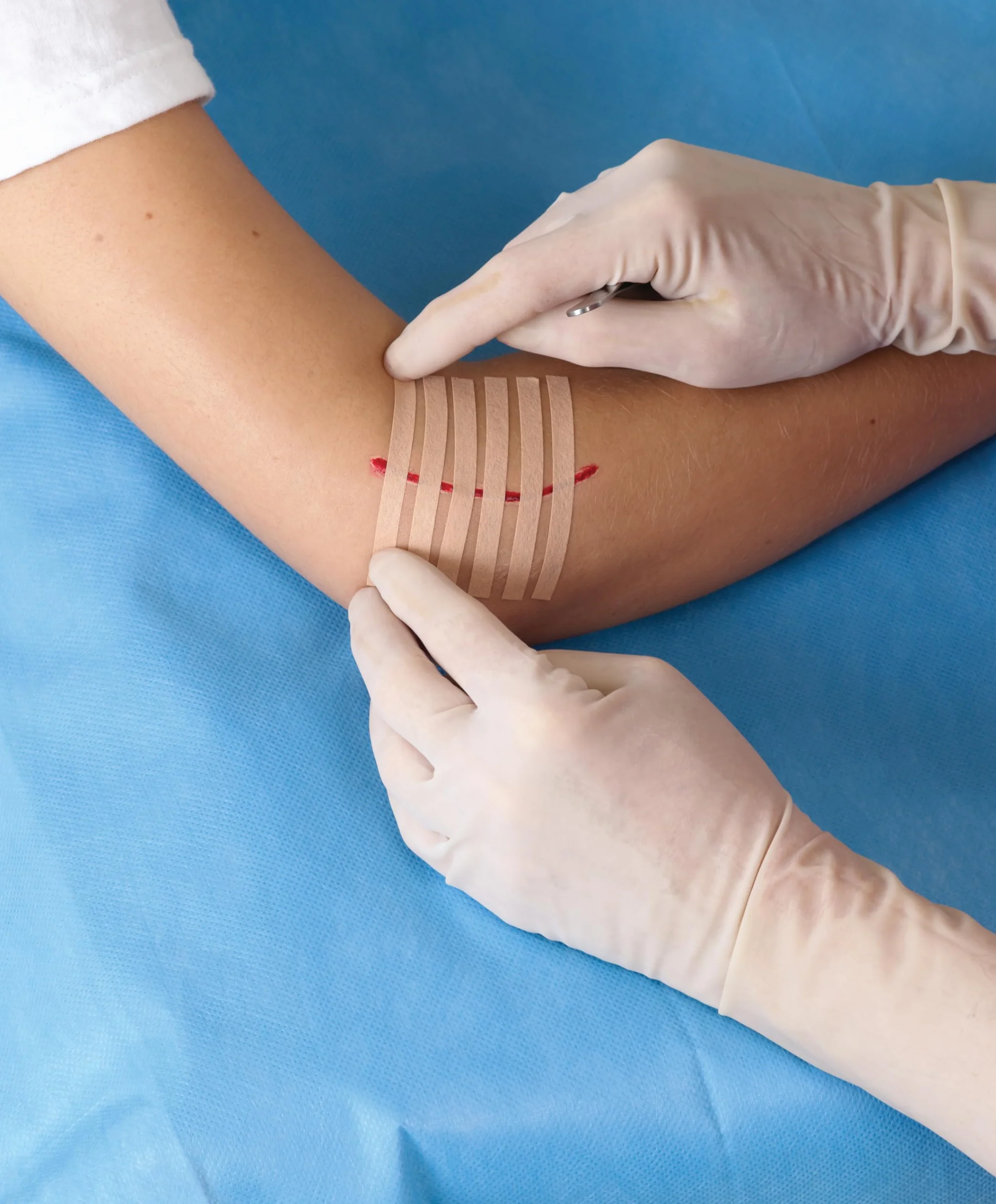 Nexcare Steri-Strip Szwy skórne 6 mm x 75 mm 6 sztuk