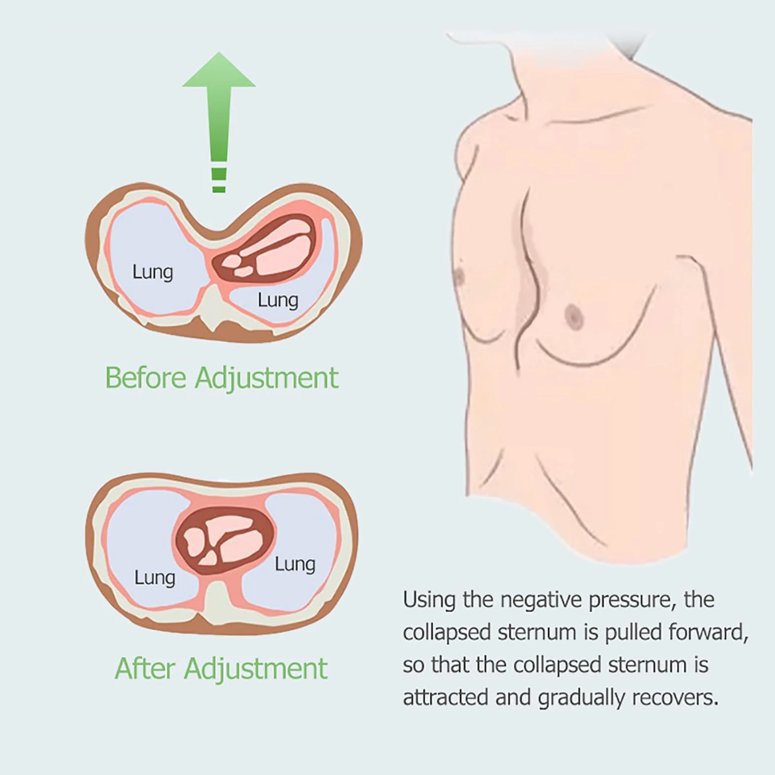 Pectus Excavatum dzwonek próżniowy, niechirurgiczne leczenie deformacji klatki piersiowej, silikonowy kubek klasy medycznej, dla dorosłych i nastolatków, wygodne dopasowanie