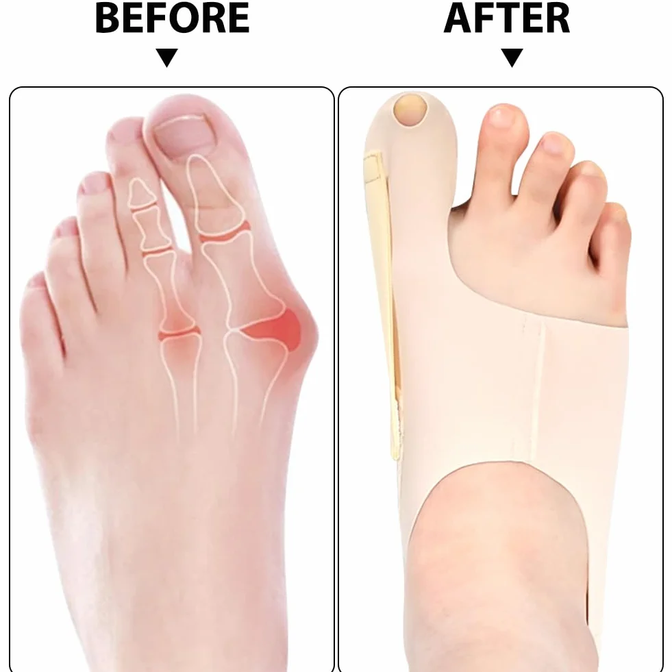 RANJIMA Korekta haluksów, 1 para, korekta Valgus, separator palców, korekta palucha, poduszka na paluch, korekta Hallux Valgus, skarpety Valgus, ulga dla dużego palca, bandaże z wbudowanym silikonowym