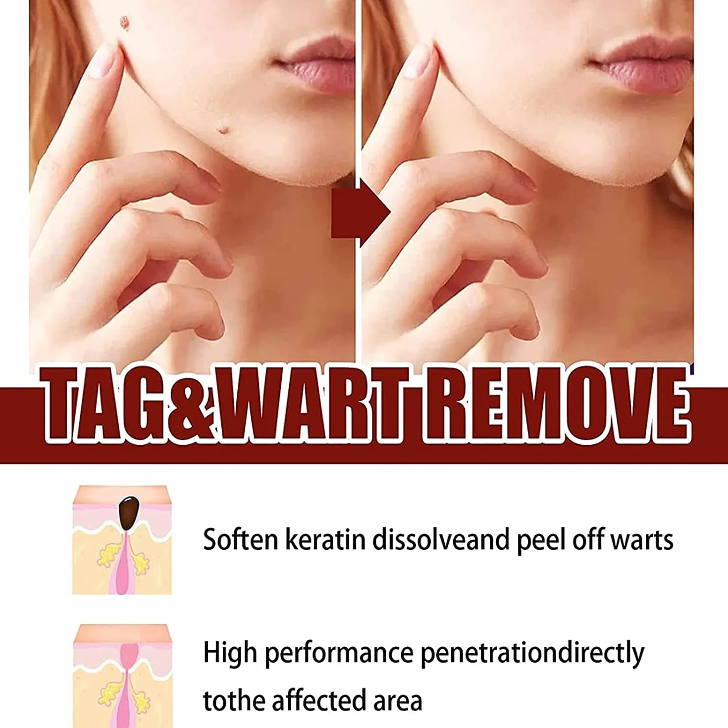Skin Tag Remover & Mole Remover Wipeoff Tags, 3 Pcs, Quick Safe Remove