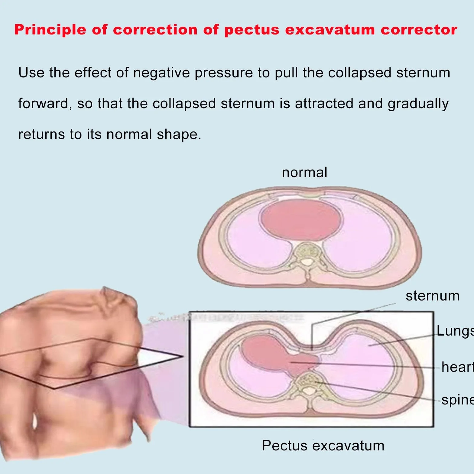 Pectus Excavatum Bańka próżniowa Orteza korekta fizyczna zmywalna monitorowanie ciśnienia S-S