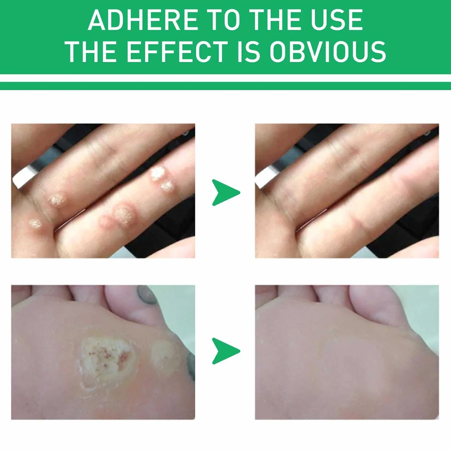 Active Corn Remover Strengthen Gel,Corn Remover Gel Extra Strength, Instant Blemish Removal Gel,Wart Remover Liquid,Corn Remover Liquid for Feet Toes Hands Care,Easy to Remove Calluses (1pcs)