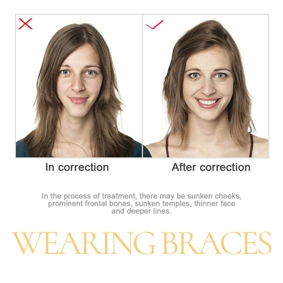 Aligner Chewies do lejek Invisalign, 6 szt. Uciskarki do lejków Aligner, Uciskarki do lejków do aparatów ortodontycznych
