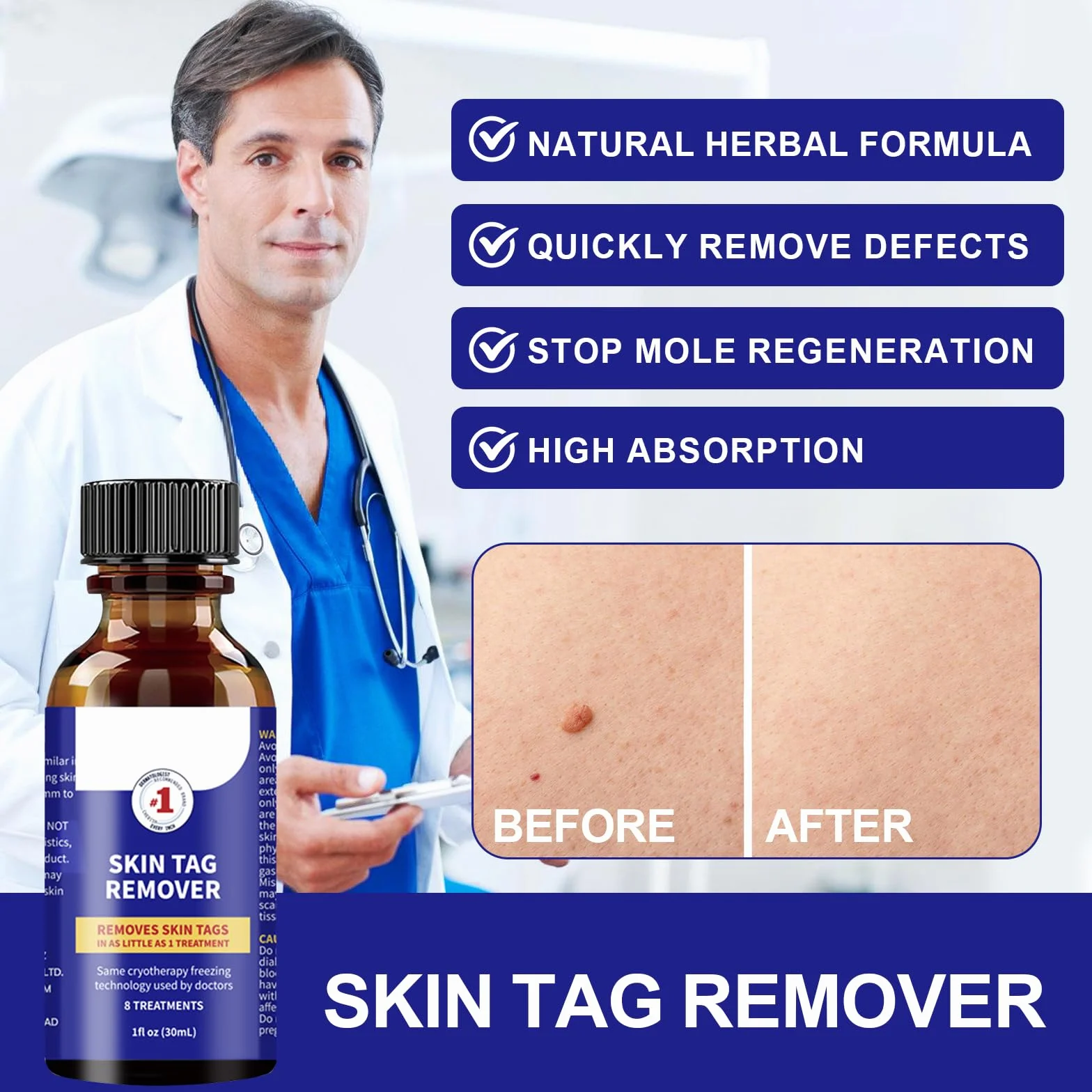 Brodawki Remover 30 ml Płyn Do Usuwania Brodawek Na Dłoniach i Stopach
