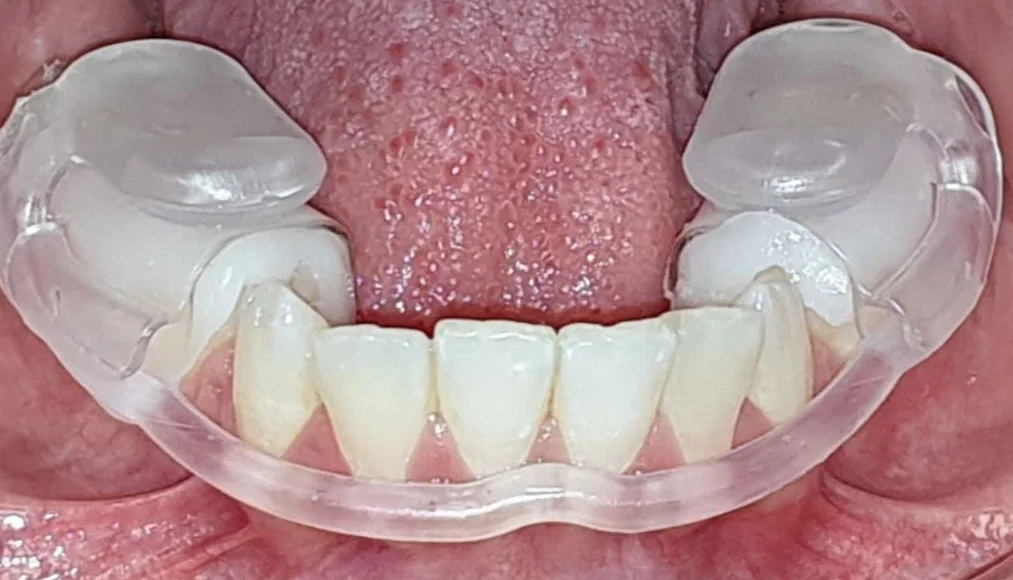 thermo prefabrykowana szyna do wgryzienia CMD, natychmiastowa pomoc w przypadku bólu stawu skroniowo-żuchwowego, rozluźnienie mięśni, niedożywiona, nie zapobiega chrupieniu, Made in Germany