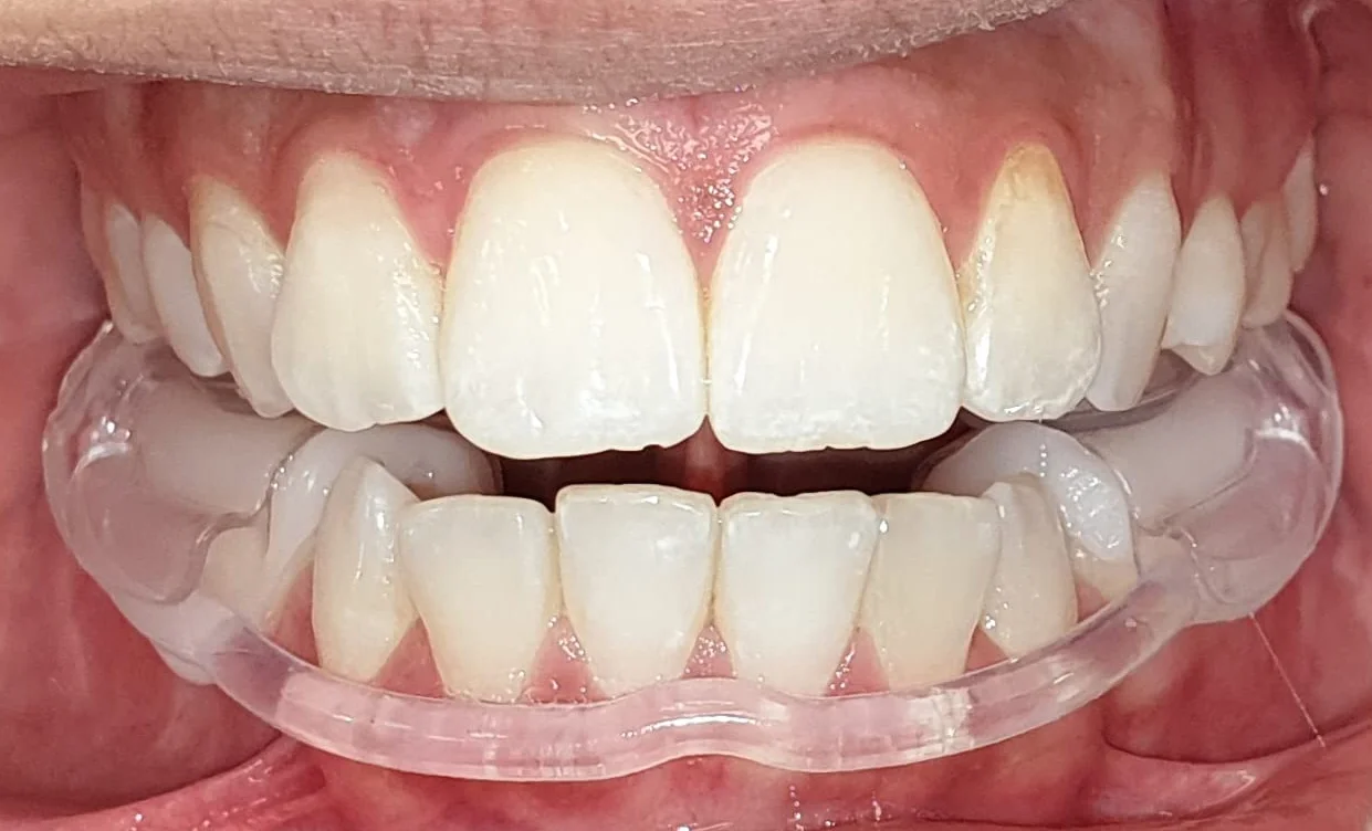 thermo prefabrykowana szyna do wgryzienia CMD, natychmiastowa pomoc w przypadku bólu stawu skroniowo-żuchwowego, rozluźnienie mięśni, niedożywiona, nie zapobiega chrupieniu, Made in Germany