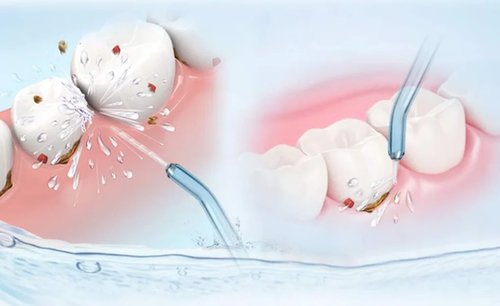 YanBan Zamienne końcówki dysz, wkłady do wkładów wysokociśnieniowych, kompatybilne z WaterPik Flosser WP-100 WP-450 WP-250 WP-300 WP-660 WP-900 (2 szt.)