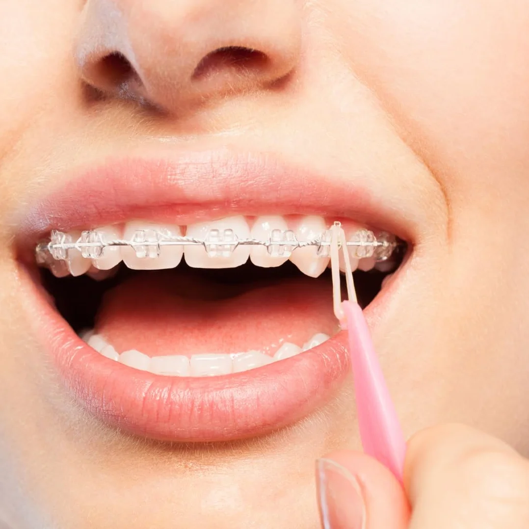 WeddHuis 8 sztuk jednorazowe elastyczne ortodontyczne plastikowe szelki materiał Umieszczenie elastyczne narzędzia do usuwania liny hak